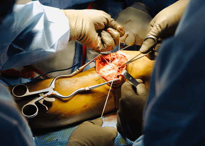 Cirugía de rodilla - Traumatólogo y Ortopedista