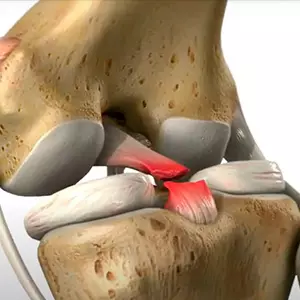 Lesión de Rodilla - Traumatólogo y Ortopedista